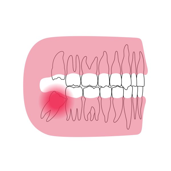 دندان‌های عقل