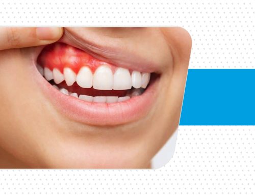 خونریزی لثه