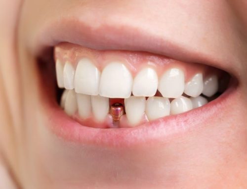 ایمپلنت‌ دندان چیست؟