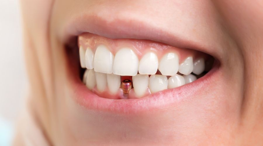 ایمپلنت‌ دندان